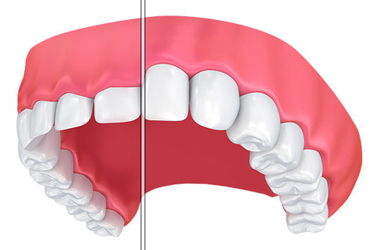 Gum Contouring