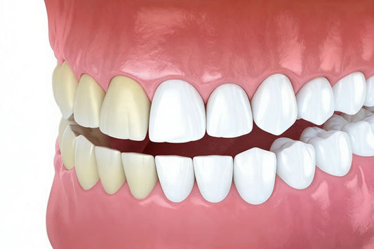 Teeth Whitening