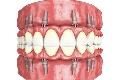 All-On-6 Implants (2 Jaws)