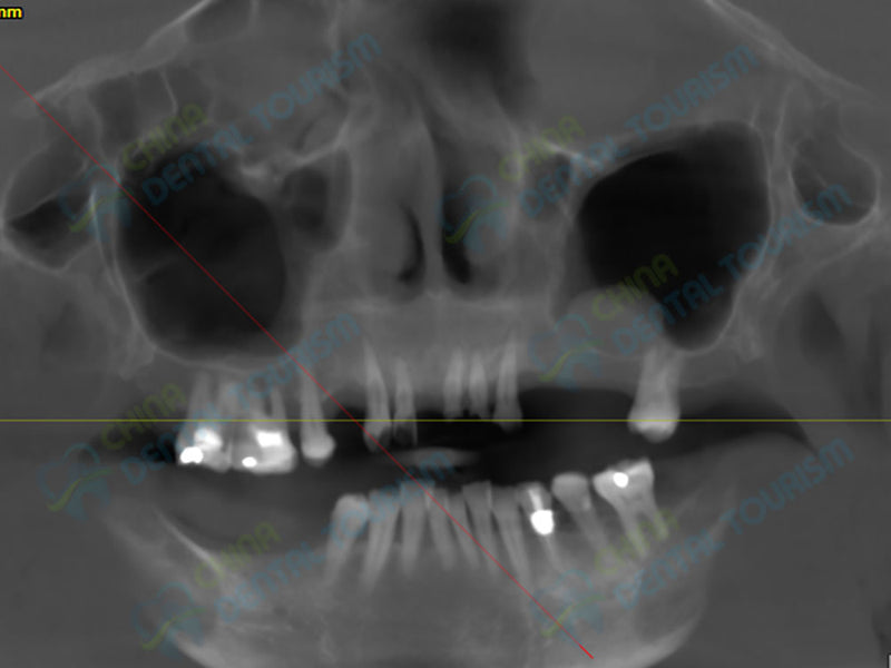 X-Ray