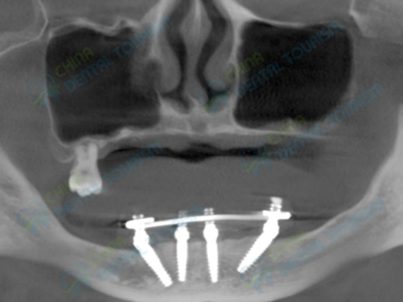 X-Ray