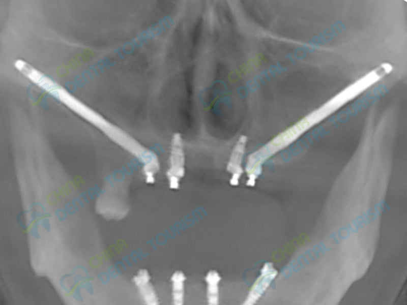 X-Ray