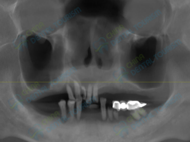 X-Ray