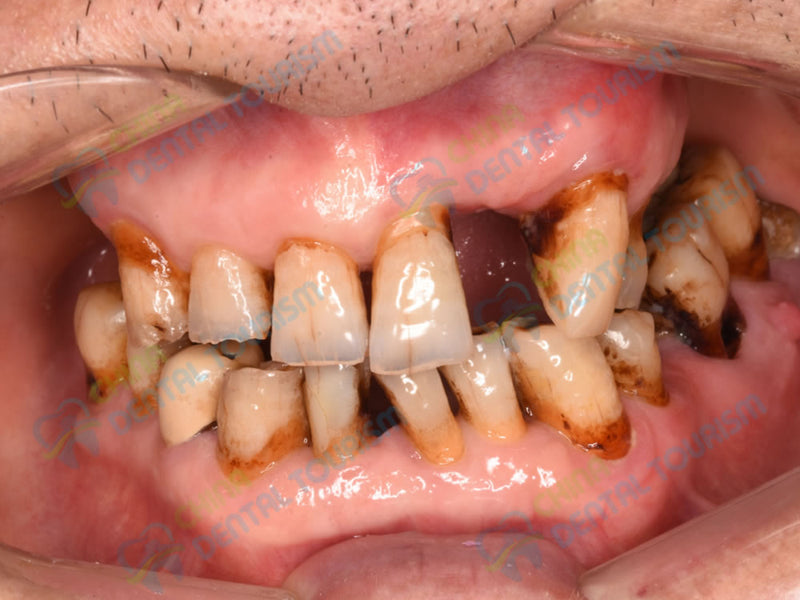 After Prosthetic