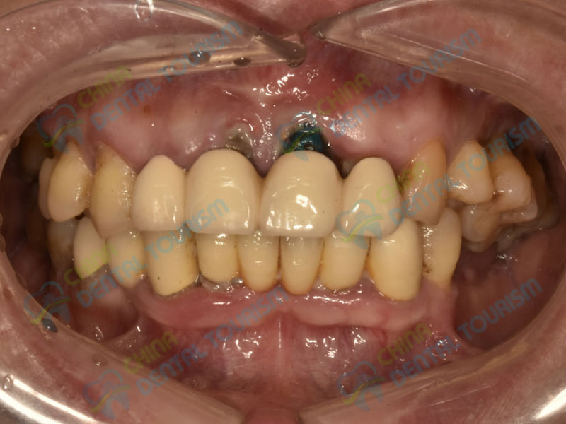 After Prosthetic