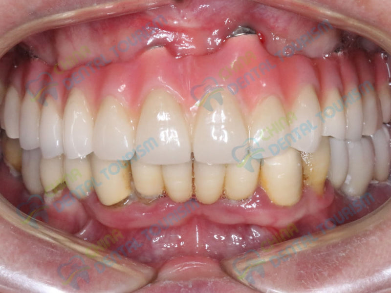 After Prosthetic
