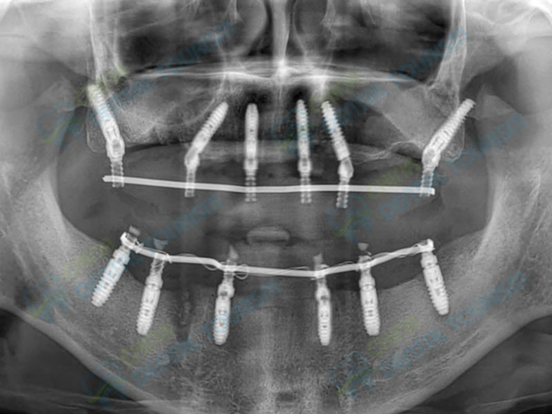 X-Ray