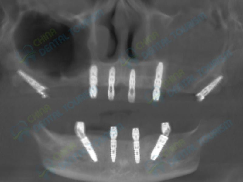 X-Ray