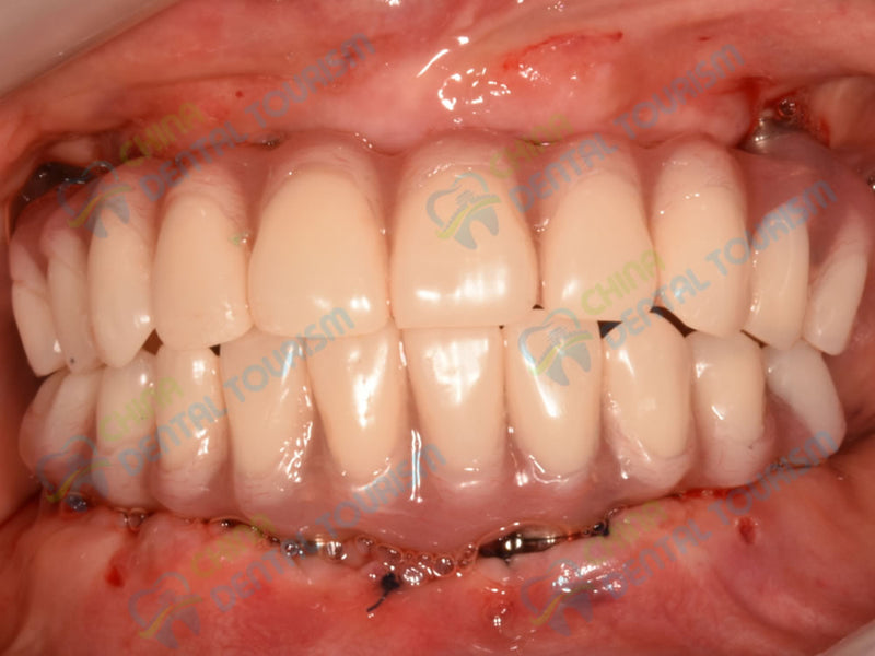 After Prosthetic