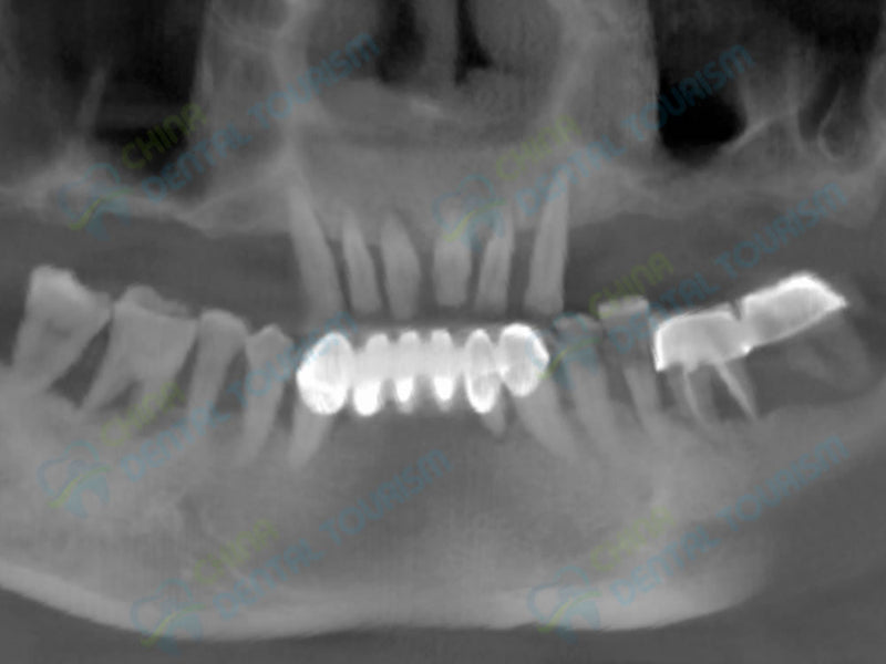 X-Ray