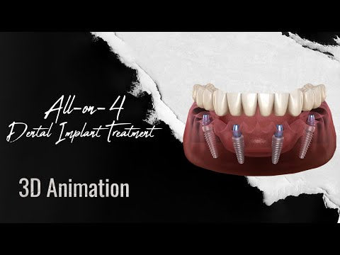 All-On-4 Implants (1 Jaw)