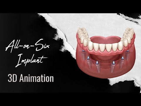 All-On-6 Implants (1 Jaw)