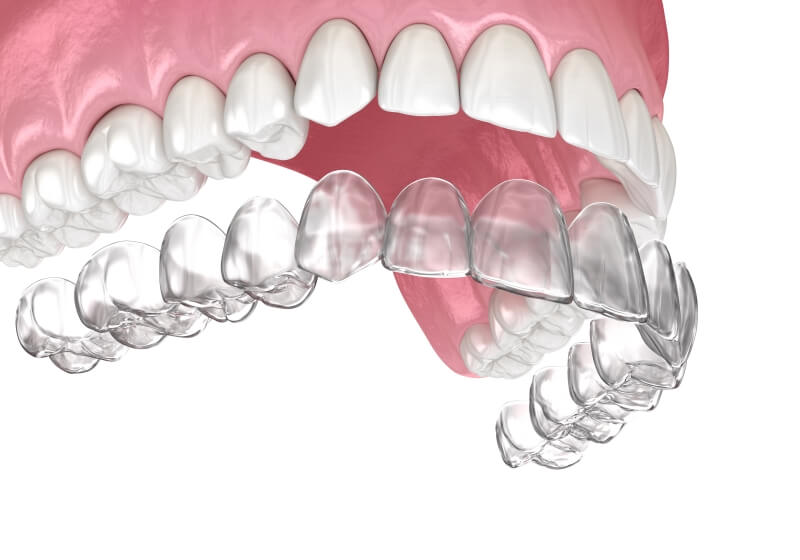 Invisible Aligners